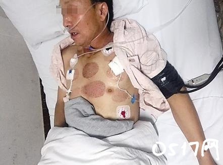 针灸被刺破双肺 中医队伍里也不乏一些庸医