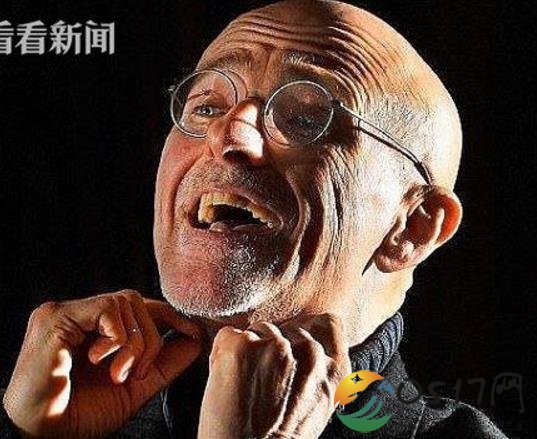 人类首例头移植手术 成功将两具尸体进行换头