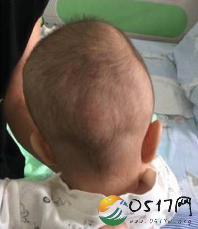 3D打印再造男婴颅骨 诊断后竟患上了颅缝早闭