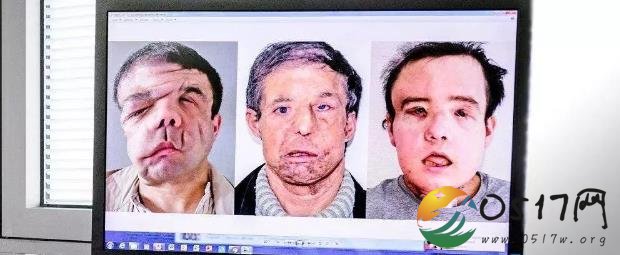 全球首例二次换脸 男子两次换脸手术很成功