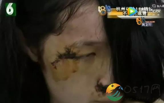 女子被骑手撞毁容 一句道歉都没有称公司有保险