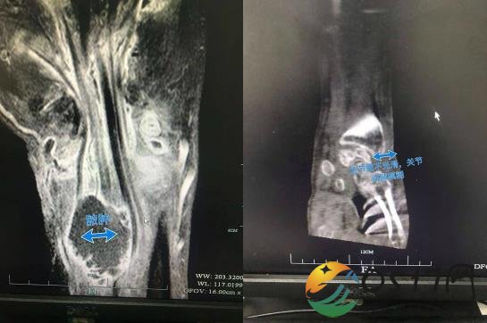 男子被虾刺中险被截肢 究竟是怎么回事
