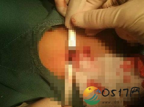 男童气管被狗咬穿 目前孩子的情况如何
