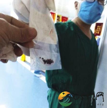 吃烧烤被蒙面追赶 受伤男子腿部取出铁砂弹