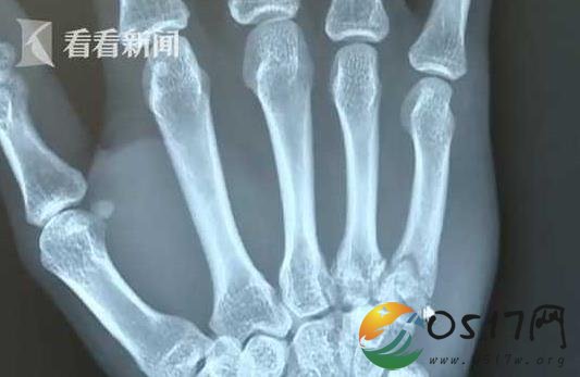 28岁男子看世界杯把手拍断 只因支持的球队踢不好
