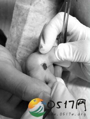 被蜱虫咬伤丧命 被蜱虫咬伤后该如何处理