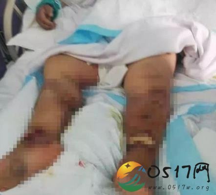 虾尾刺破手指身亡 处理海鲜需要最好是戴上手套