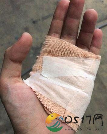昆凌拍戏受伤晒照 周杰伦看到后立即买奶茶去安慰