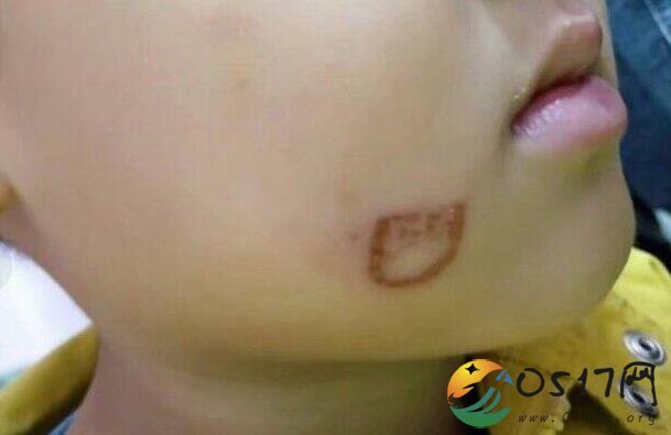 幼儿园老师用打火机烫伤孩子脸 教育孩子都是这么教育的吗