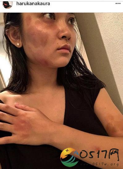蒋劲夫行踪不明 蒋劲夫女友晒淤青照证实与自己有关