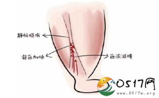 女孩崴脚后身亡 为何崴脚会这么严重